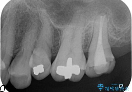 歯周外科で整備する安定したクラウン環境の治療前