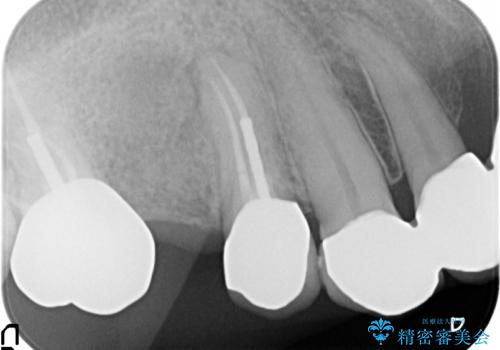 オールセラミッククラウン 治療途中の歯の補綴の治療後