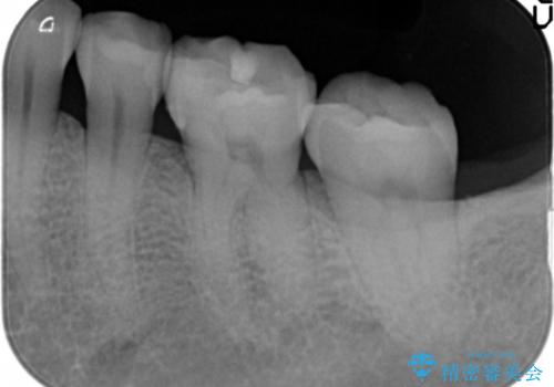 目立つ銀歯を全て白く　セラミックで虫歯治療の治療後