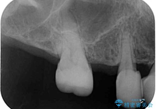 歯の欠損を放置 オールセラミックブリッジによる補綴治療の治療前