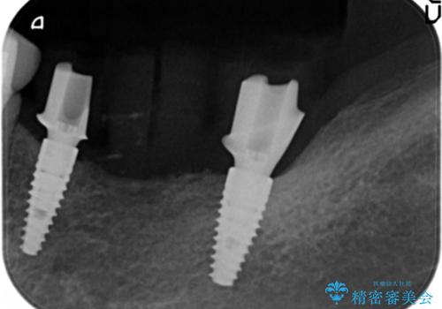 インプラントで咬合機能を取り戻すの治療中