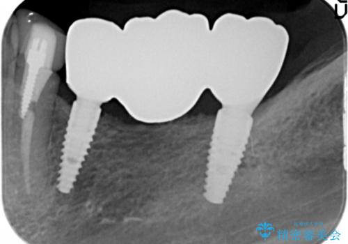 インプラントで咬合機能を取り戻すの治療後