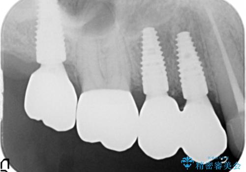 [強すぎる咬合力]　破折歯のインプラントによる咬合機能回復治療の治療後