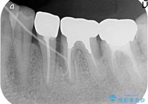 親知らずの移植 70代男性の治療前