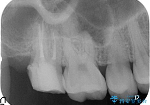 オールセラミッククラウン 他院にて抜歯と言われた歯の治療の治療中