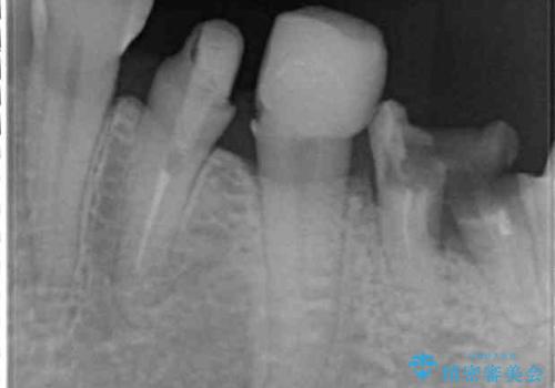 歯の欠損を放置 オールセラミックブリッジによる補綴治療の治療前