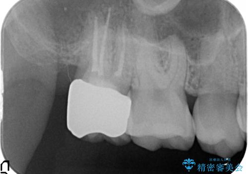 オールセラミッククラウン 他院にて抜歯と言われた歯の治療の治療後