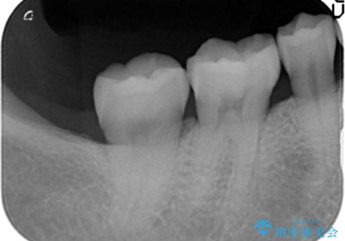 銀歯を白く セラミックインレーにの治療後