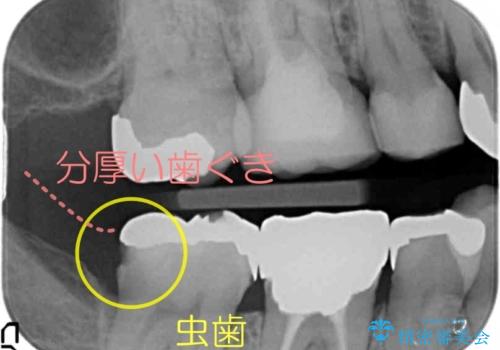 下の奥歯の虫歯　歯周外科手術を含めた治療