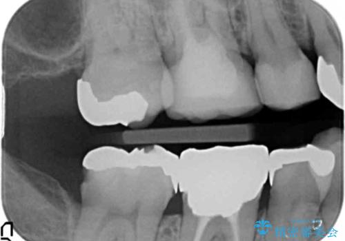 下の奥歯の虫歯　歯周外科手術を含めた治療の治療前