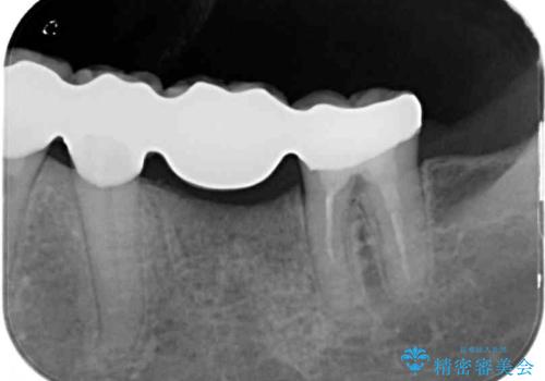歯の欠損を放置 オールセラミックブリッジによる補綴治療の治療後