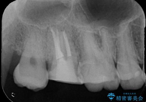 [フルジルコニアクラウン] 老朽化した銀歯を白くの治療中