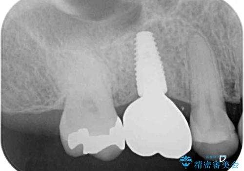 抜歯になった虫歯 奥歯のインプラント治療の治療後