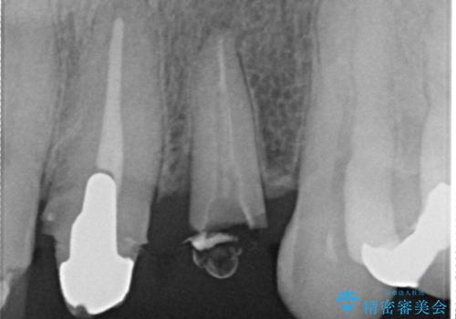 オールセラミッククラウン 前歯のブリッジ 気になる見た目の改善の治療前