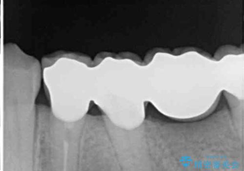 歯の欠損を放置 オールセラミックブリッジによる補綴治療の治療後