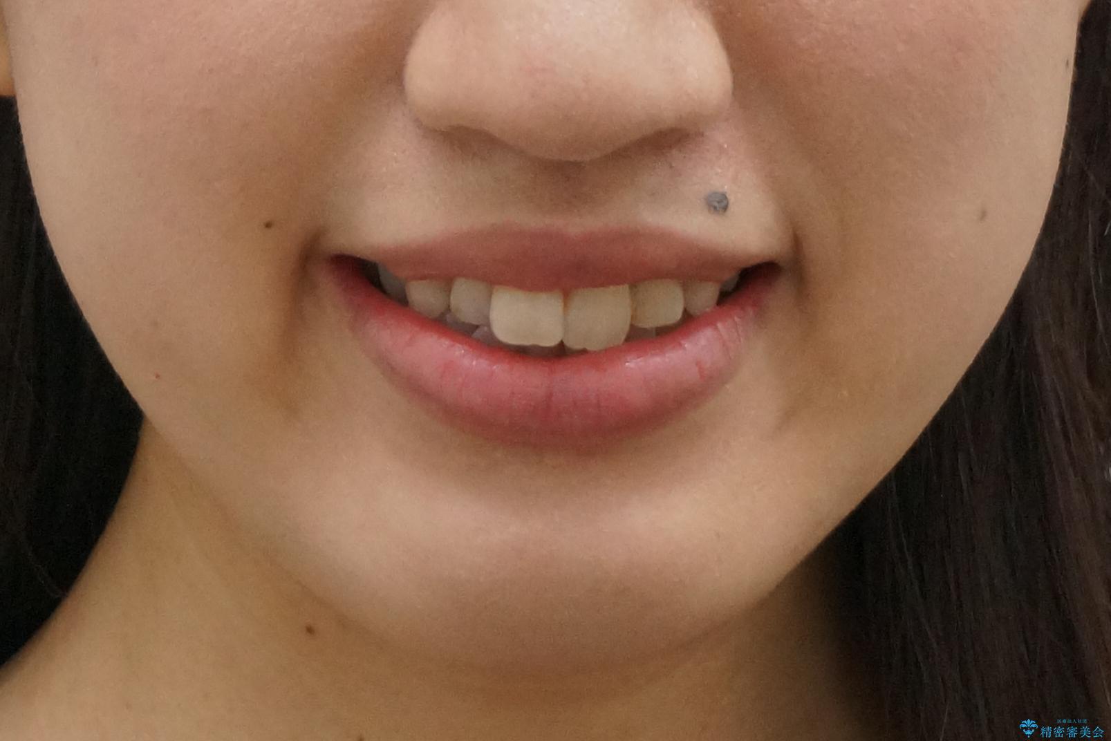 上下の前歯のがたつき　歯を抜かずに矯正の治療前（顔貌）