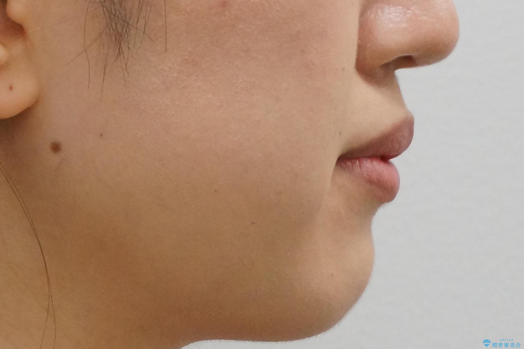 上下の前歯のがたつき 歯を抜かずに矯正の治療前(顔貌)