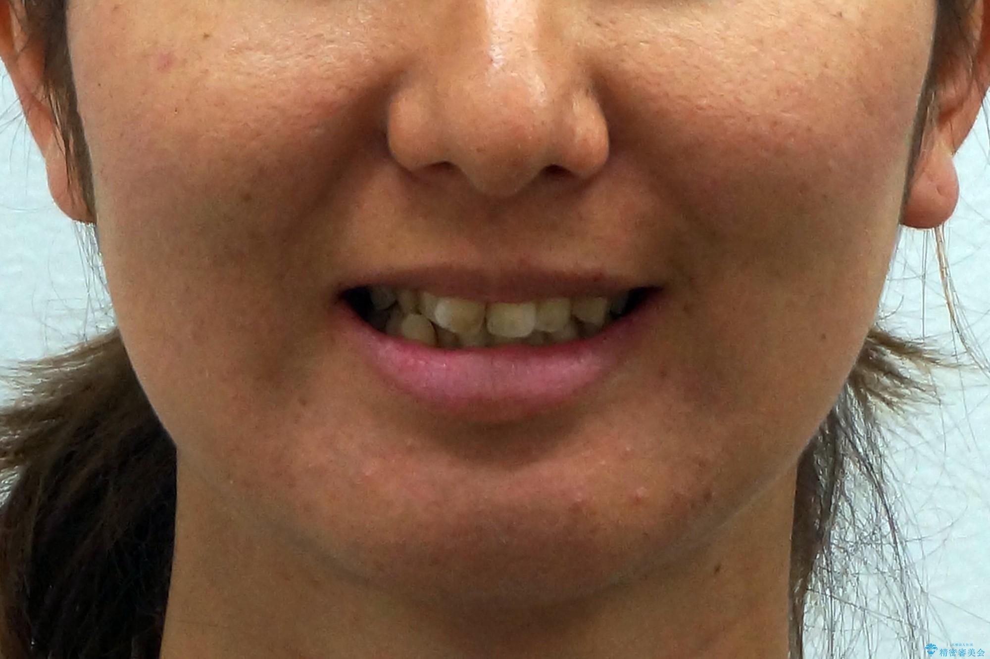30代女性　残った乳歯を抜いてスペースを閉じる矯正　前歯のねじれの治療前（顔貌）