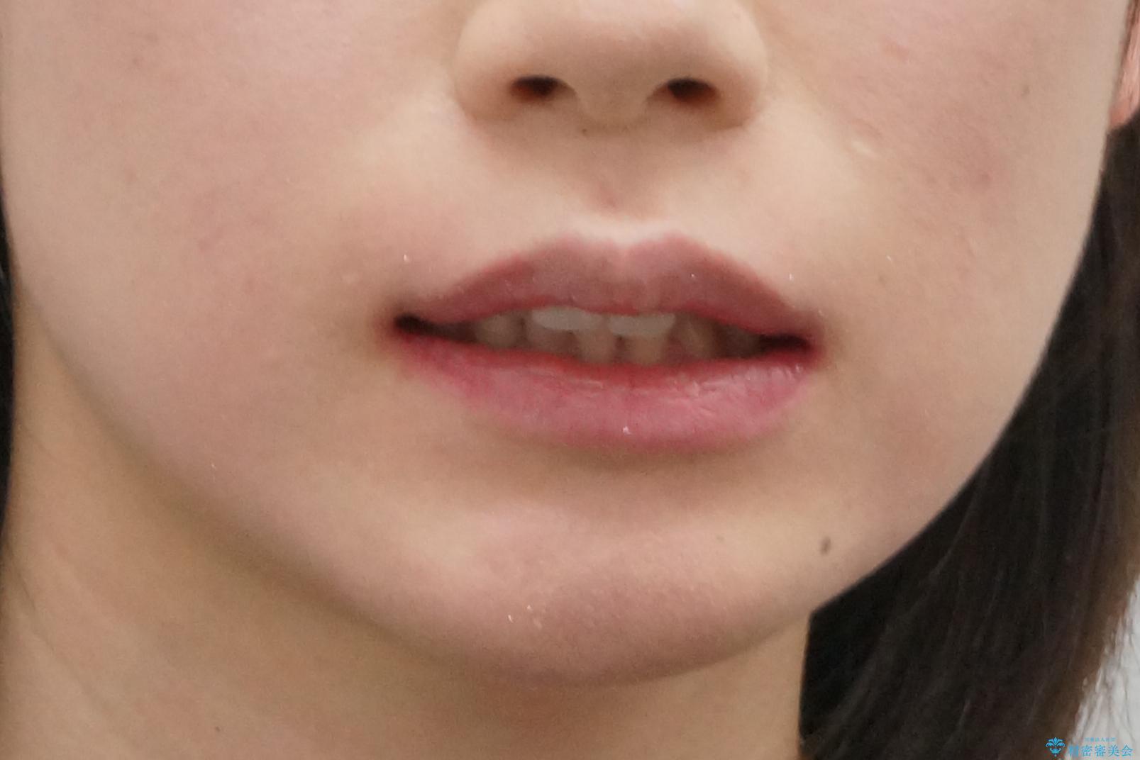 軽度の前歯のがたつき 下の前歯が生まれつき少ないの治療前(顔貌)