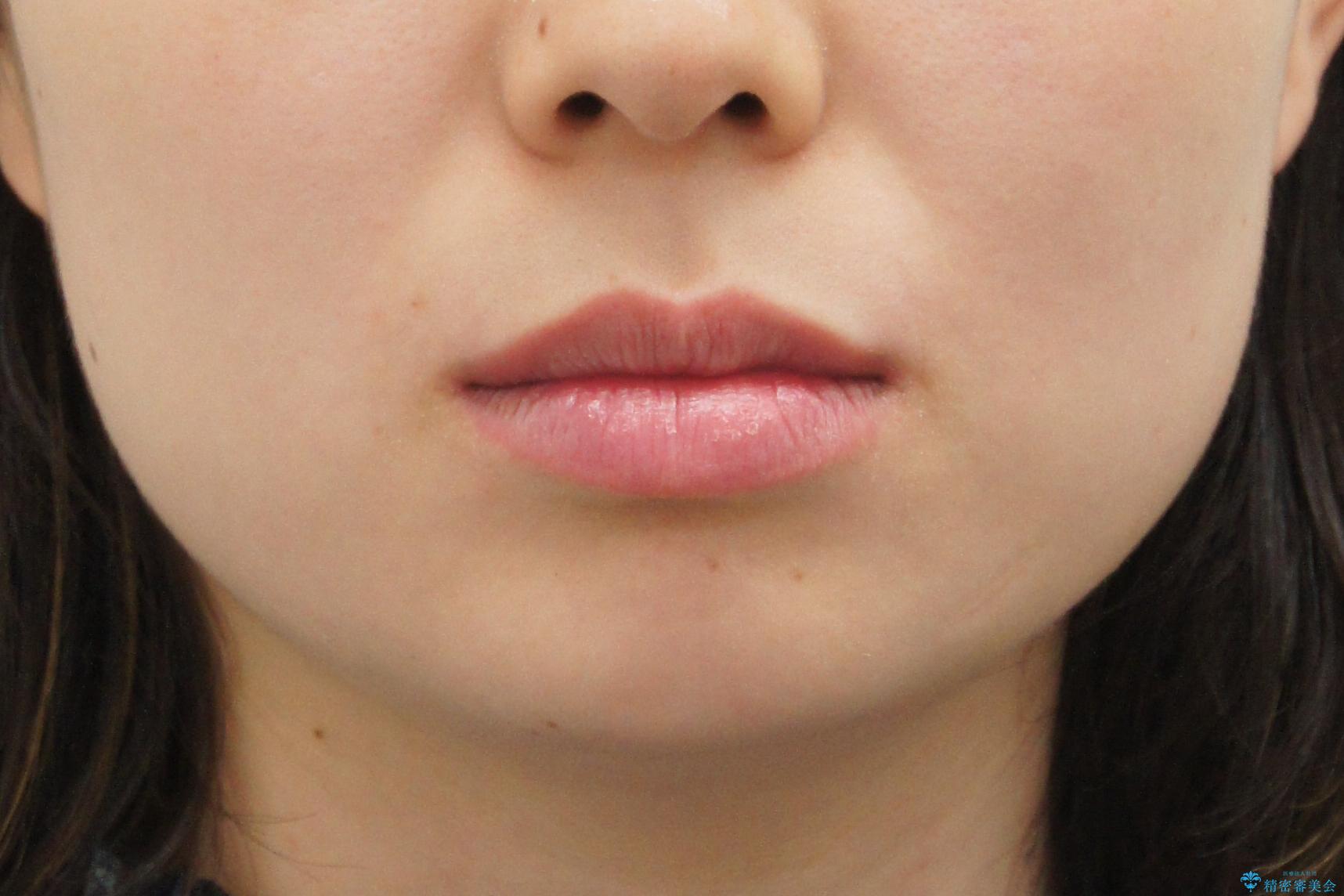 受け口の改善 歯を抜かずに矯正の治療前(顔貌)