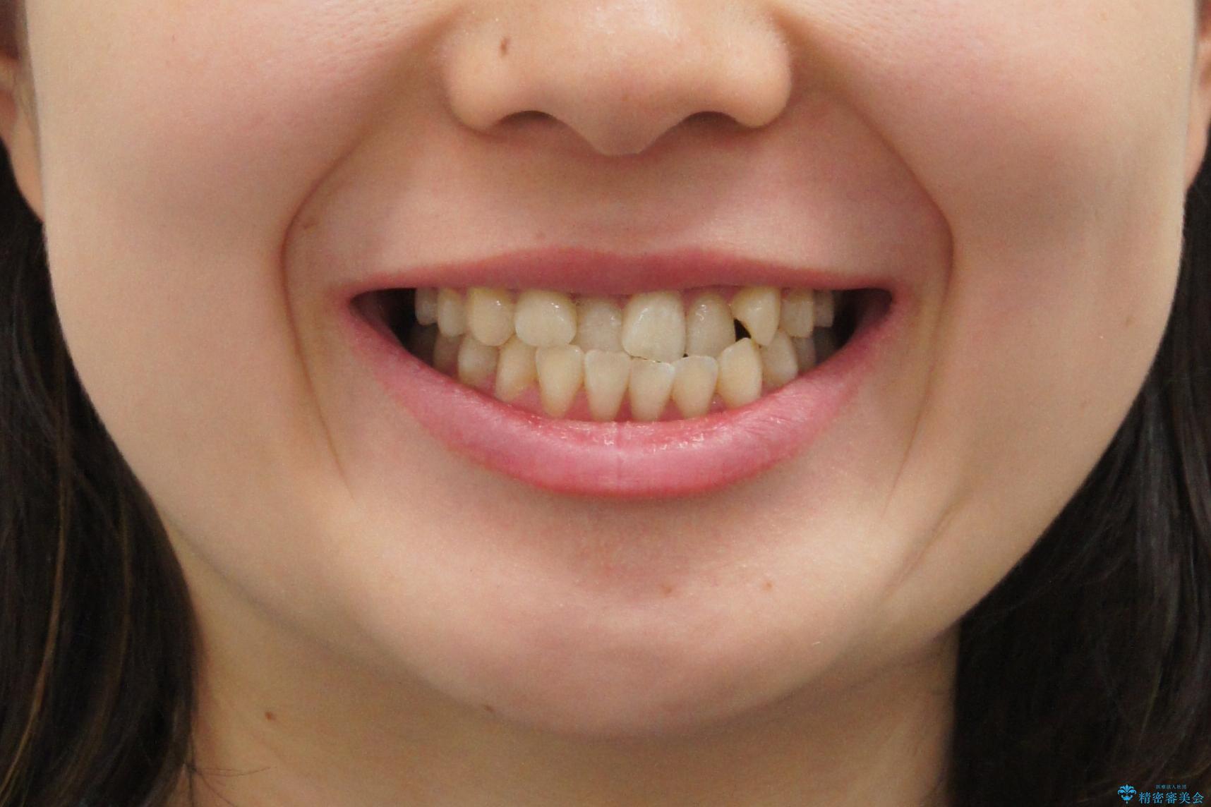 受け口の改善 歯を抜かずに矯正の治療前(顔貌)