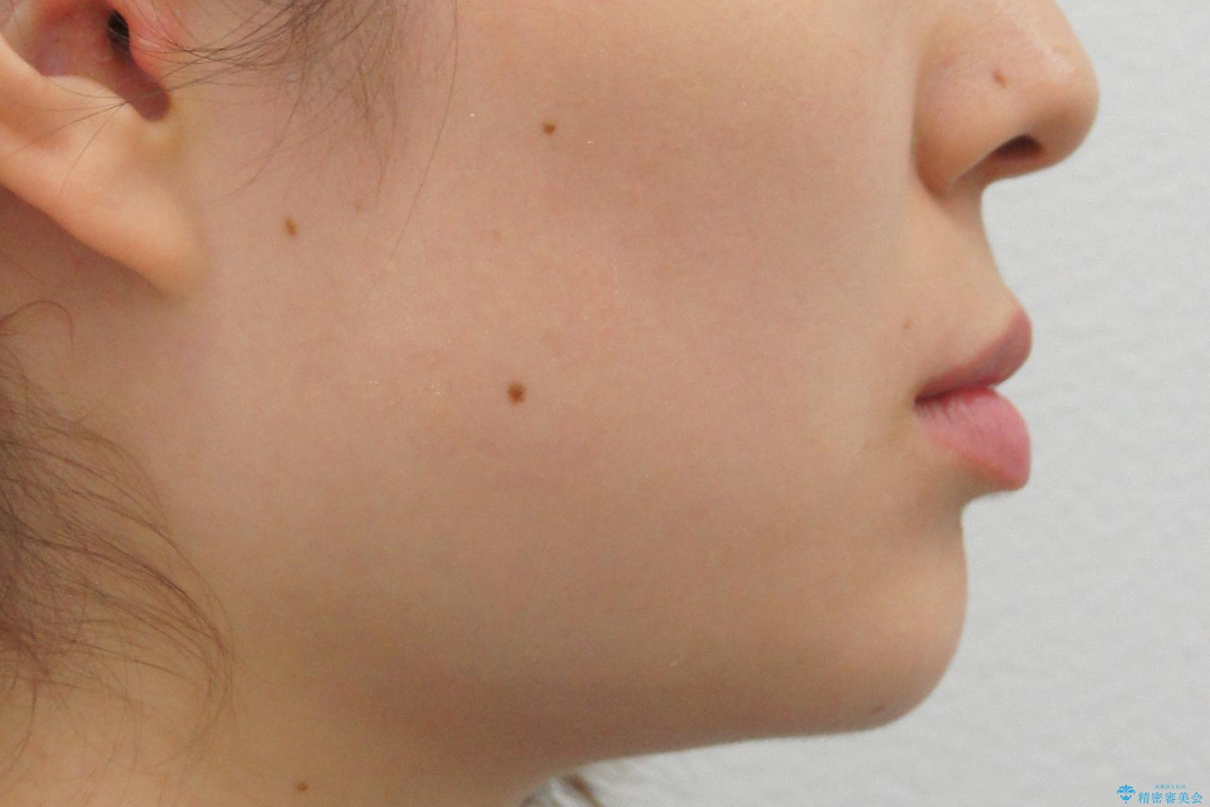 受け口の改善 歯を抜かずに矯正の治療前(顔貌)