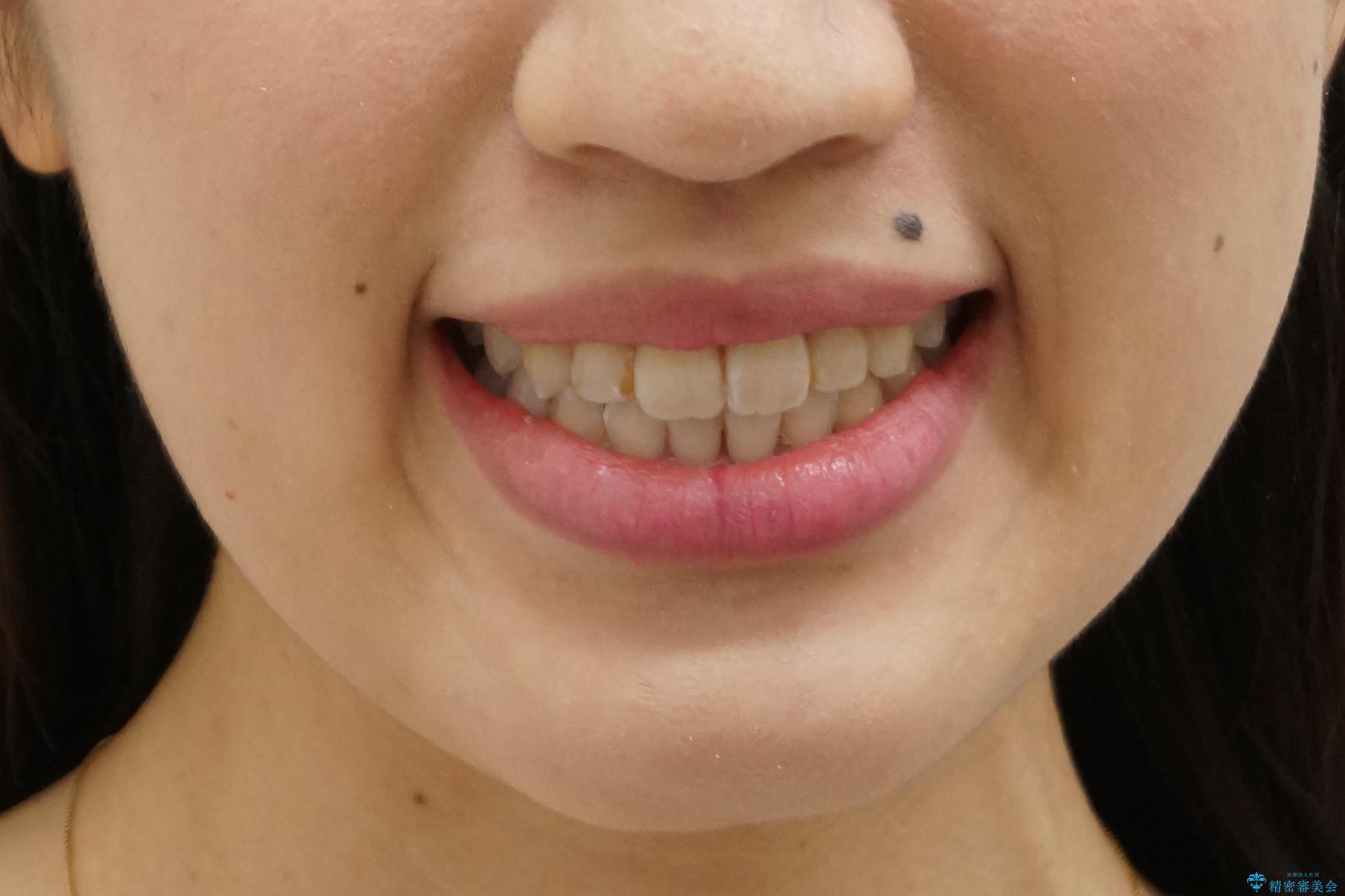 上下の前歯のがたつき 歯を抜かずに矯正の治療後(顔貌)