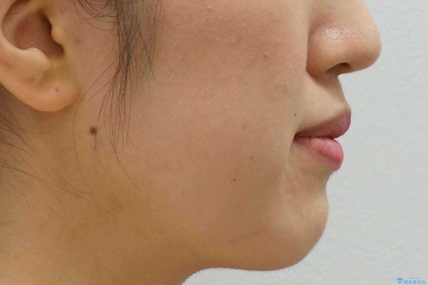 上下の前歯のがたつき 歯を抜かずに矯正の治療後(顔貌)