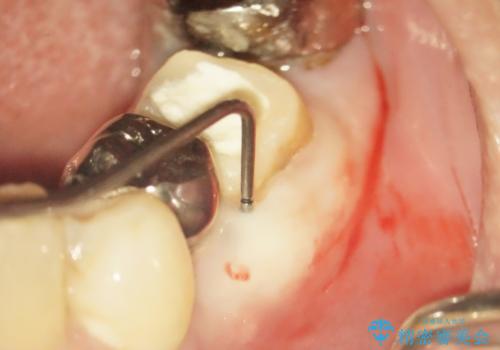 親知らずの移植 70代男性