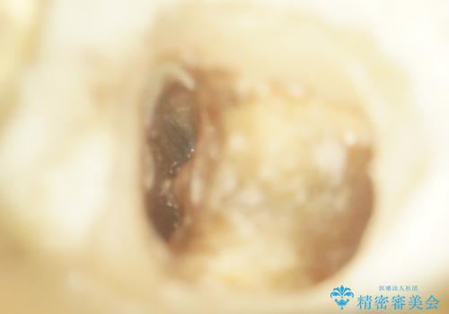 親知らずの移植 70代男性の治療中