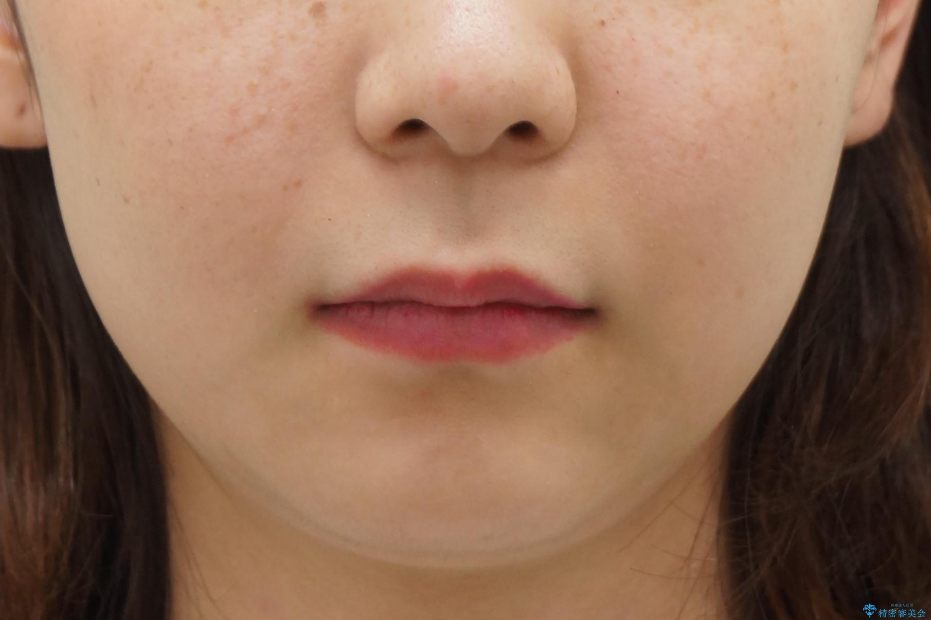 前歯のがたつき 過蓋咬合の治療後(顔貌)