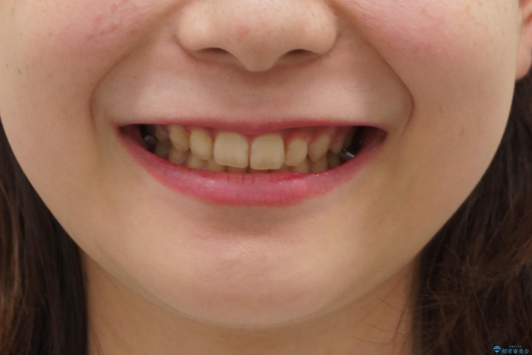 前歯のがたつき　過蓋咬合の治療後（顔貌）