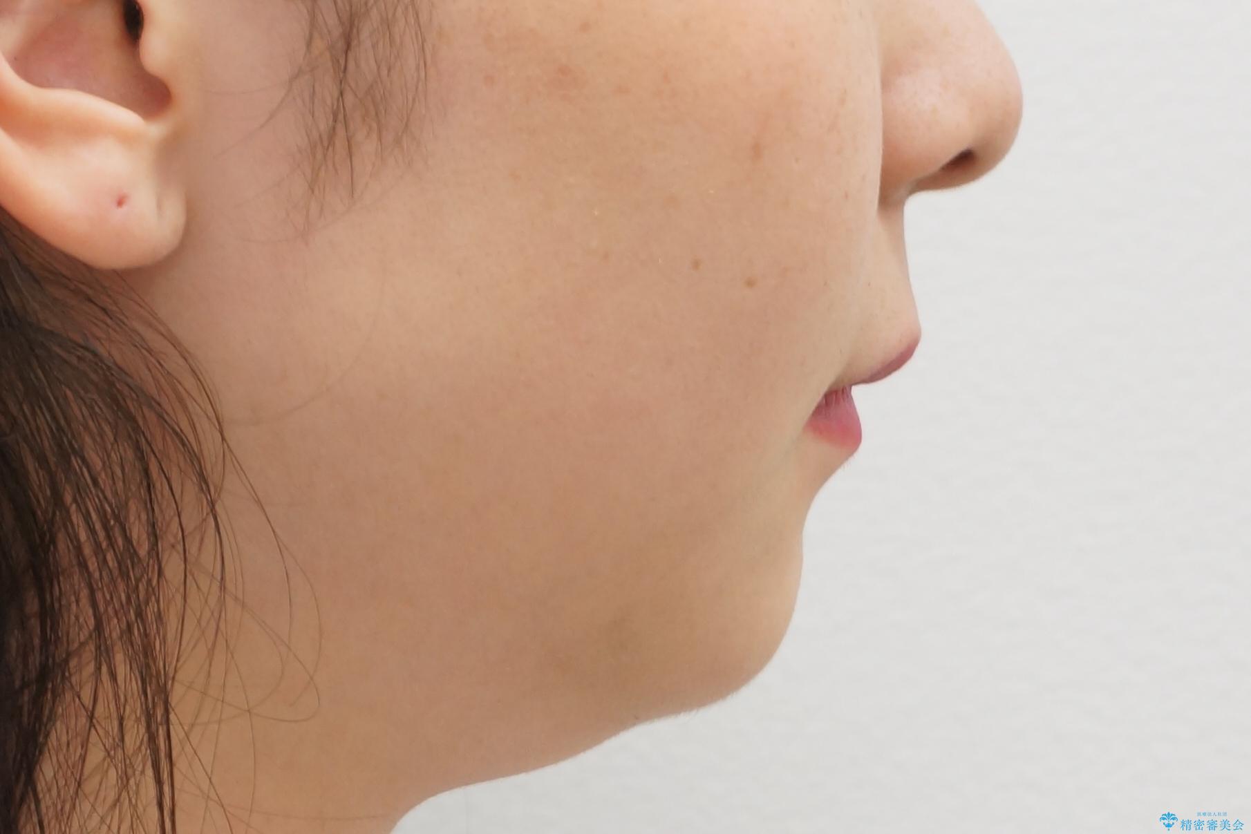 前歯のがたつき 過蓋咬合の治療後(顔貌)