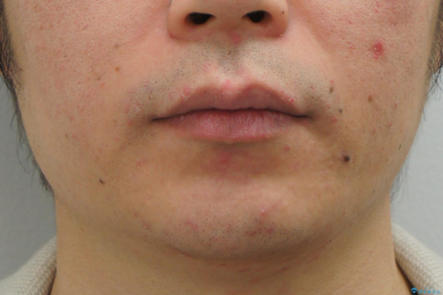 前歯のねじれを 1年かけずに矯正 インビザラインの治療前(顔貌)