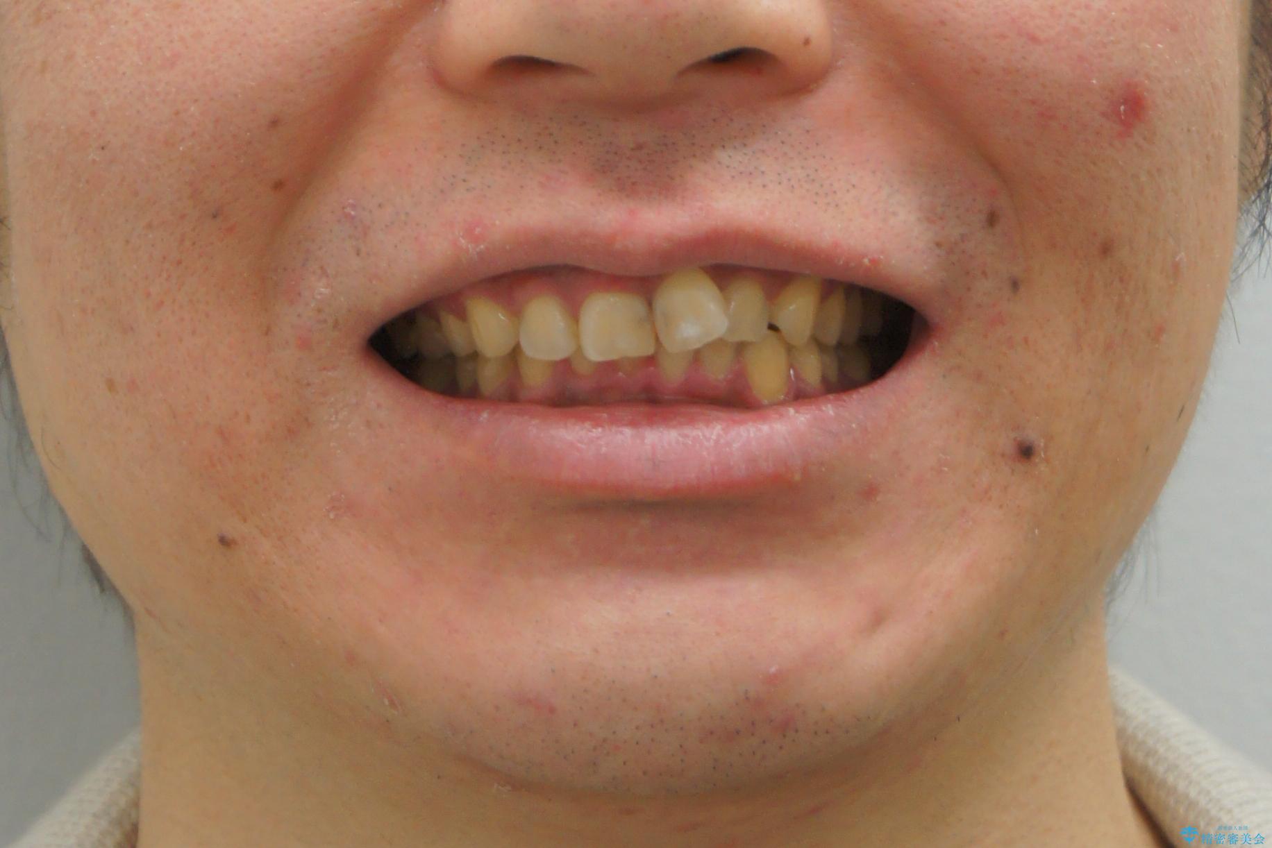 前歯のねじれを　1年かけずに矯正　インビザラインの治療前（顔貌）