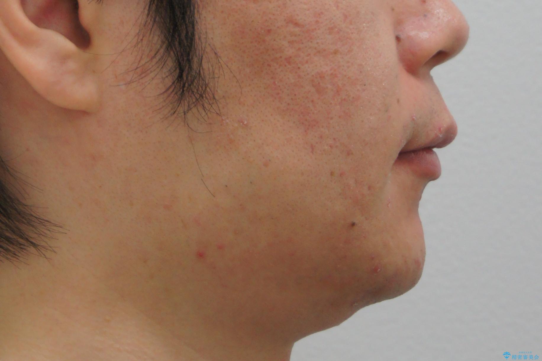 前歯のねじれを 1年かけずに矯正 インビザラインの治療前(顔貌)