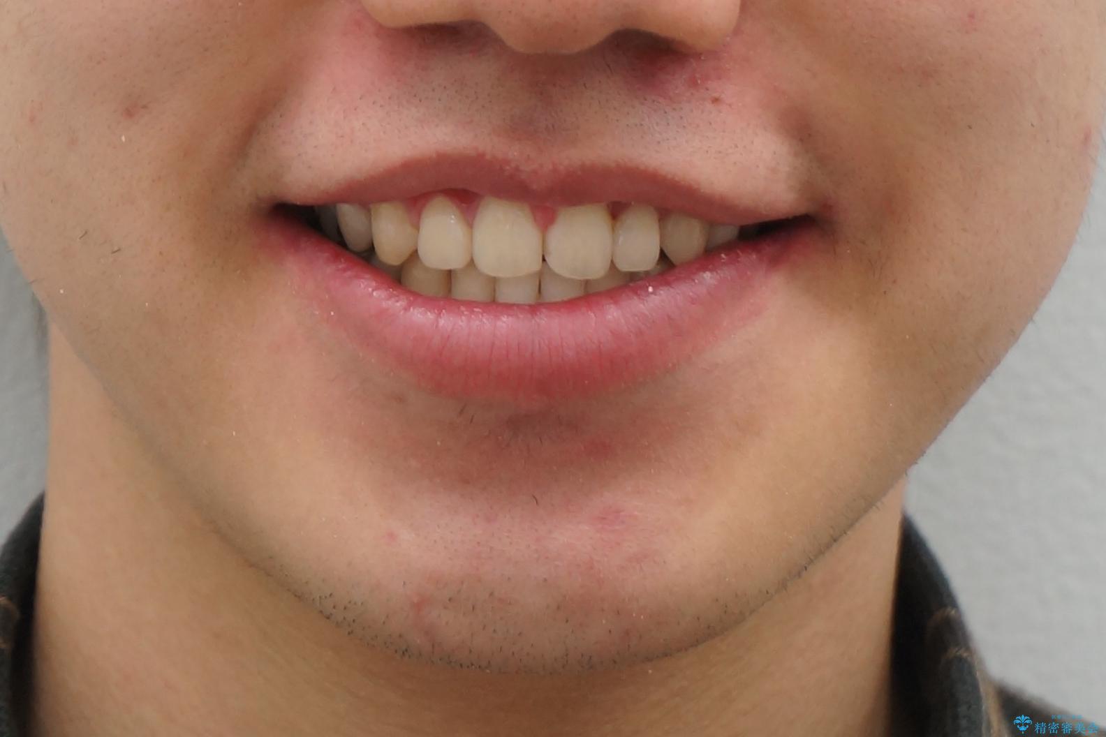 前歯のねじれ　上だけ部分矯正でコストダウンの治療後（顔貌）