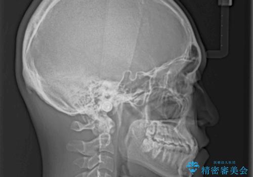 美容歯科でも断られた 著しい前歯のクロスバイトをワイヤー矯正で改善の治療前