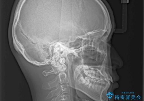 前歯のクロスバイト インビザラインによる矯正治療の治療前