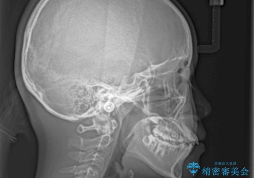 乳歯が残っている 目立たない装置での抜歯矯正の治療前