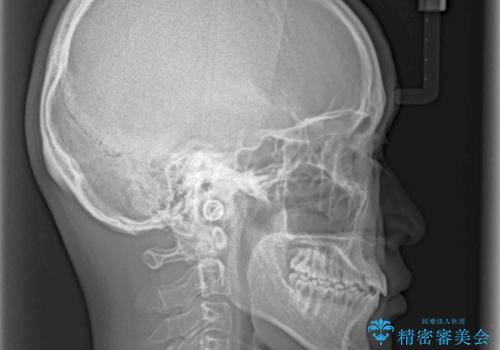 前歯のクロスバイト インビザラインによる矯正治療の治療後