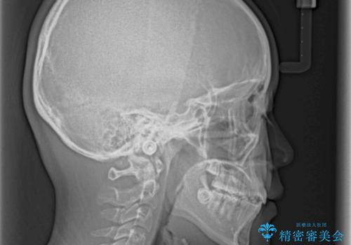 乳歯が残っている 目立たない装置での抜歯矯正の治療後