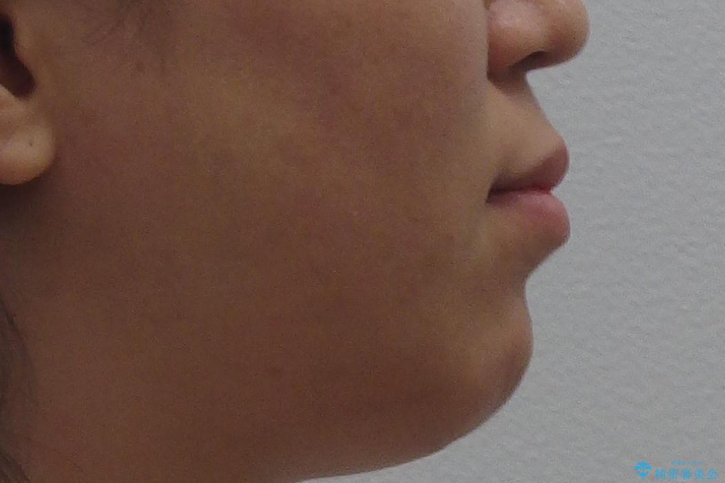 再矯正 一度抜かないでやったが、やっぱり抜いて口元下げたいの治療前(顔貌)