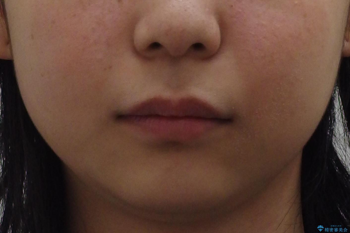 前歯のがたつき 過蓋咬合の治療前(顔貌)