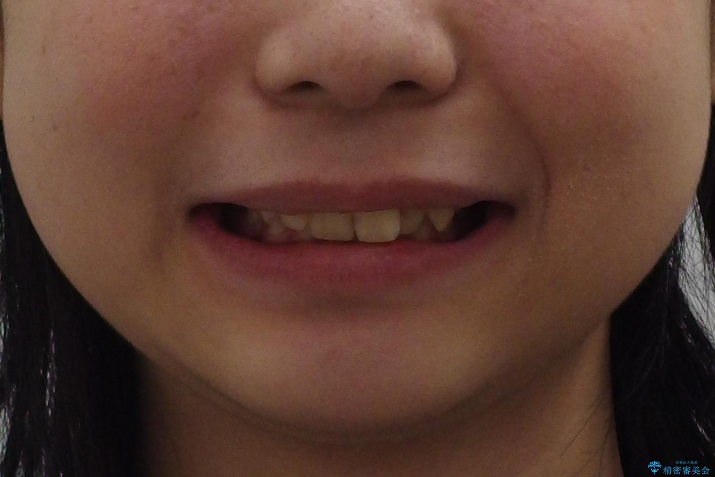 前歯のがたつき 過蓋咬合の治療前(顔貌)