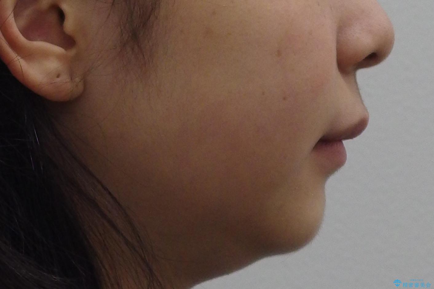 前歯のがたつき 過蓋咬合の治療前(顔貌)