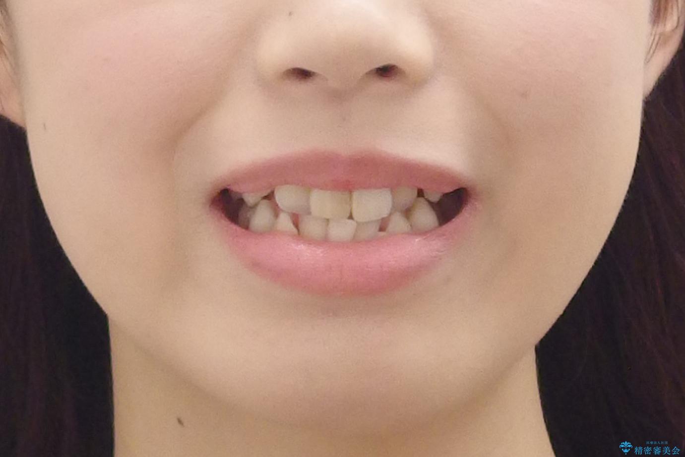 前歯の変色 セラミックで ホワイトニングも併用の治療前(顔貌)