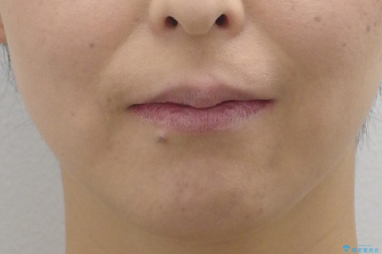 40代の矯正 出っ歯、歯のがたがたの治療前(顔貌)