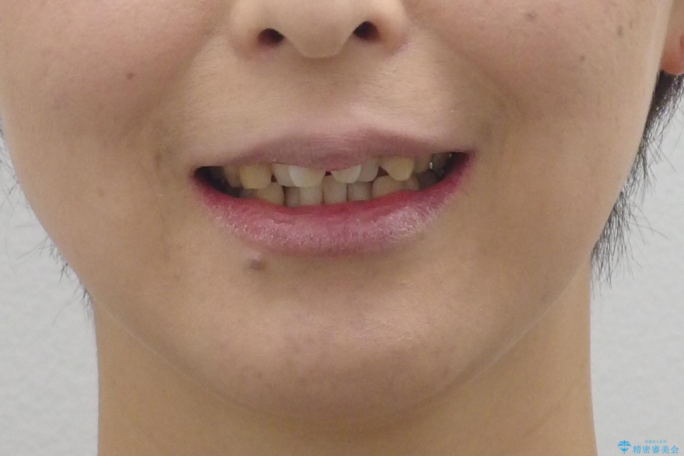 40代の矯正　出っ歯、歯のがたがたの治療前（顔貌）
