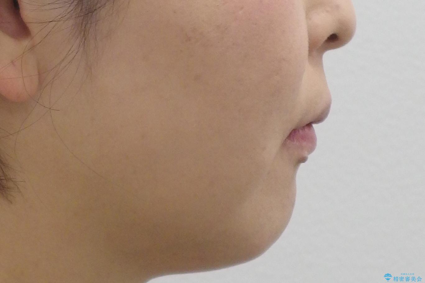 40代の矯正 出っ歯、歯のがたがたの治療前(顔貌)